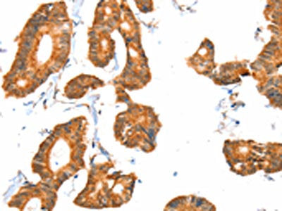The image on the left is immunohistochemistry of paraffin-embedded Human colon cancer tissue using CSB-PA776608(ACOX1 Antibody) at dilution 1/40, on the right is treated with fusion protein. (Original magnification: ×200)