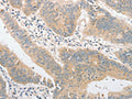 The image on the left is immunohistochemistry of paraffin-embedded Human colon cancer tissue using CSB-PA776633(TLR4 Antibody) at dilution 1/40, on the right is treated with fusion protein. (Original magnification: ×200)