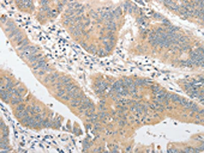 The image on the left is immunohistochemistry of paraffin-embedded Human colon cancer tissue using CSB-PA776633(TLR4 Antibody) at dilution 1/40, on the right is treated with fusion protein. (Original magnification: ×200)