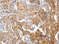 The image on the left is immunohistochemistry of paraffin-embedded Human lung cancer tissue using CSB-PA776767(ADA Antibody) at dilution 1/15, on the right is treated with fusion protein. (Original magnification: ×200)
