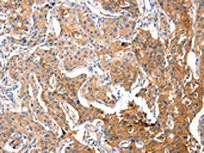 The image on the left is immunohistochemistry of paraffin-embedded Human lung cancer tissue using CSB-PA776767(ADA Antibody) at dilution 1/15, on the right is treated with fusion protein. (Original magnification: ×200)
