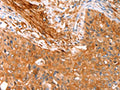 The image on the left is immunohistochemistry of paraffin-embedded Human cervical cancer tissue using CSB-PA777001(CNN3 Antibody) at dilution 1/15, on the right is treated with fusion protein. (Original magnification: ×200)