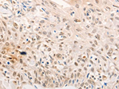 The image is immunohistochemistry of paraffin-embedded Human esophagus cancer tissue using CSB-PA777165(NOX4 Antibody) at dilution 1/30. (Original magnification: ×200)