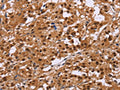 The image on the left is immunohistochemistry of paraffin-embedded Human thyroid cancer tissue using CSB-PA777238(CTNNBL1 Antibody) at dilution 1/50, on the right is treated with fusion protein. (Original magnification: ×200)