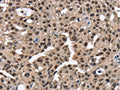 The image on the left is immunohistochemistry of paraffin-embedded Human breast cancer tissue using CSB-PA777302(RNF40 Antibody) at dilution 1/25, on the right is treated with fusion protein. (Original magnification: ×200)