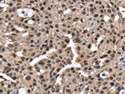 The image on the left is immunohistochemistry of paraffin-embedded Human breast cancer tissue using CSB-PA777302(RNF40 Antibody) at dilution 1/25, on the right is treated with fusion protein. (Original magnification: ×200)