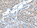 The image on the left is immunohistochemistry of paraffin-embedded Human lung cancer tissue using CSB-PA777393(ADAMTSL1 Antibody) at dilution 1/15, on the right is treated with fusion protein. (Original magnification: ×200)