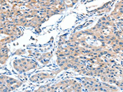 The image on the left is immunohistochemistry of paraffin-embedded Human lung cancer tissue using CSB-PA777393(ADAMTSL1 Antibody) at dilution 1/15, on the right is treated with fusion protein. (Original magnification: ×200)