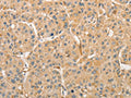 The image on the left is immunohistochemistry of paraffin-embedded Human liver cancer tissue using CSB-PA777675(ATG3 Antibody) at dilution 1/30, on the right is treated with fusion protein. (Original magnification: ×200)