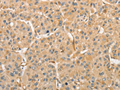 The image on the left is immunohistochemistry of paraffin-embedded Human liver cancer tissue using CSB-PA777675(ATG3 Antibody) at dilution 1/30, on the right is treated with fusion protein. (Original magnification: ×200)