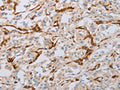 The image on the left is immunohistochemistry of paraffin-embedded Human thyroid cancer tissue using CSB-PA777739(MYL6 Antibody) at dilution 1/50, on the right is treated with fusion protein. (Original magnification: ×200)