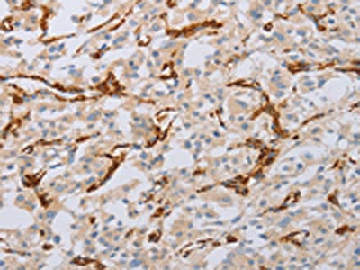 The image on the left is immunohistochemistry of paraffin-embedded Human thyroid cancer tissue using CSB-PA777739(MYL6 Antibody) at dilution 1/50, on the right is treated with fusion protein. (Original magnification: ×200)