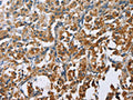 The image on the left is immunohistochemistry of paraffin-embedded Human thyroid cancer tissue using CSB-PA777748(CARD9 Antibody) at dilution 1/60, on the right is treated with fusion protein. (Original magnification: ×200)