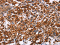 The image on the left is immunohistochemistry of paraffin-embedded Human thyroid cancer tissue using CSB-PA777986(ING2 Antibody) at dilution 1/40, on the right is treated with fusion protein. (Original magnification: ×200)