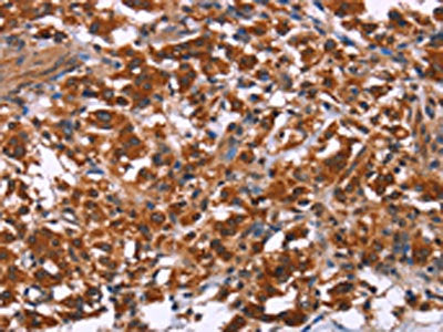The image on the left is immunohistochemistry of paraffin-embedded Human thyroid cancer tissue using CSB-PA777986(ING2 Antibody) at dilution 1/40, on the right is treated with fusion protein. (Original magnification: ×200)