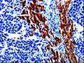 The image on the left is immunohistochemistry of paraffin-embedded Human liver cancer tissue using CSB-PA778097(EPHX1 Antibody) at dilution 1/20, on the right is treated with fusion protein. (Original magnification: ×200)