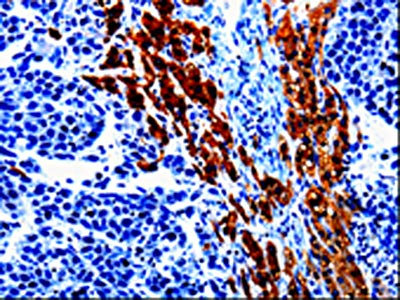 The image on the left is immunohistochemistry of paraffin-embedded Human liver cancer tissue using CSB-PA778097(EPHX1 Antibody) at dilution 1/20, on the right is treated with fusion protein. (Original magnification: ×200)