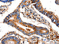The image on the left is immunohistochemistry of paraffin-embedded Human colon cancer tissue using CSB-PA778289(COX8A Antibody) at dilution 1/12, on the right is treated with fusion protein. (Original magnification: ×200)