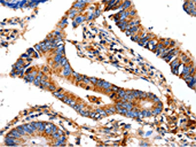 The image on the left is immunohistochemistry of paraffin-embedded Human colon cancer tissue using CSB-PA778289(COX8A Antibody) at dilution 1/12, on the right is treated with fusion protein. (Original magnification: ×200)