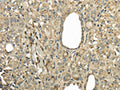 The image on the left is immunohistochemistry of paraffin-embedded Human thyroid cancer tissue using CSB-PA778345(UBE2B Antibody) at dilution 1/30, on the right is treated with fusion protein. (Original magnification: ×200)
