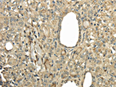 The image on the left is immunohistochemistry of paraffin-embedded Human thyroid cancer tissue using CSB-PA778345(UBE2B Antibody) at dilution 1/30, on the right is treated with fusion protein. (Original magnification: ×200)