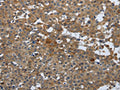 The image on the left is immunohistochemistry of paraffin-embedded Human breast cancer tissue using CSB-PA778835(PGR Antibody) at dilution 1/25, on the right is treated with synthetic peptide. (Original magnification: x200)