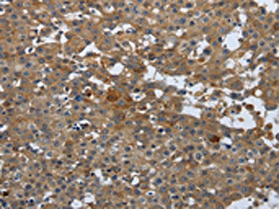 The image on the left is immunohistochemistry of paraffin-embedded Human breast cancer tissue using CSB-PA778835(PGR Antibody) at dilution 1/25, on the right is treated with synthetic peptide. (Original magnification: x200)