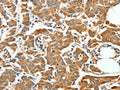 The image on the left is immunohistochemistry of paraffin-embedded Human breast cancer tissue using CSB-PA779355(ALDH9A1 Antibody) at dilution 1/50, on the right is treated with synthetic peptide. (Original magnification: ×200)