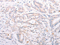 The image on the left is immunohistochemistry of paraffin-embedded Human colon cancer tissue using CSB-PA779568(ANKRA2 Antibody) at dilution 1/50, on the right is treated with synthetic peptide. (Original magnification: ×200)