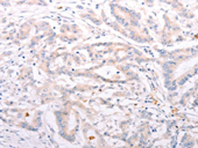 The image on the left is immunohistochemistry of paraffin-embedded Human colon cancer tissue using CSB-PA779568(ANKRA2 Antibody) at dilution 1/50, on the right is treated with synthetic peptide. (Original magnification: ×200)