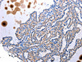The image is immunohistochemistry of paraffin-embedded Human thyroid cancer tissue using CSB-PA779618(UTS2 Antibody) at dilution 1/100. (Original magnification: ×200)