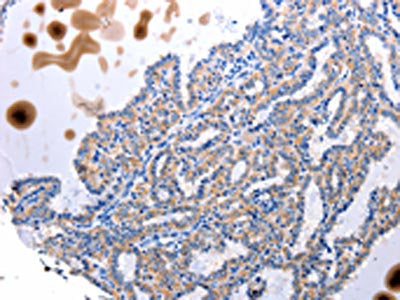 The image is immunohistochemistry of paraffin-embedded Human thyroid cancer tissue using CSB-PA779618(UTS2 Antibody) at dilution 1/100. (Original magnification: ×200)