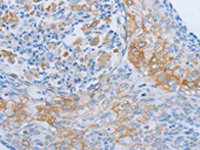 The image on the left is immunohistochemistry of paraffin-embedded Human cervical cancer tissue using CSB-PA779661(ADRB3 Antibody) at dilution 1/60, on the right is treated with synthetic peptide. (Original magnification: ×200)