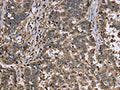 The image is immunohistochemistry of paraffin-embedded Human liver cancer tissue using CSB-PA779821(GAPDH Antibody) at dilution 1/30. (Original magnification: ×200)