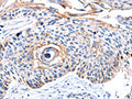 The image on the left is immunohistochemistry of paraffin-embedded Human esophagus cancer tissue using CSB-PA780138(CCNB2 Antibody) at dilution 1/10, on the right is treated with synthetic peptide. (Original magnification: ×200)