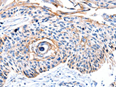 The image on the left is immunohistochemistry of paraffin-embedded Human esophagus cancer tissue using CSB-PA780138(CCNB2 Antibody) at dilution 1/10, on the right is treated with synthetic peptide. (Original magnification: ×200)