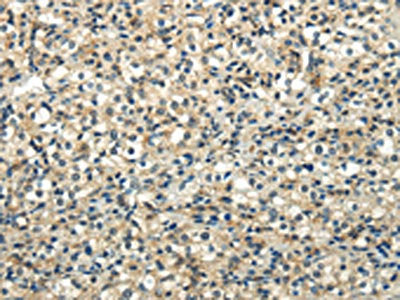 The image on the left is immunohistochemistry of paraffin-embedded Human prostate cancer tissue using CSB-PA780157(WNT2 Antibody) at dilution 1/35, on the right is treated with synthetic peptide. (Original magnification: ×200)