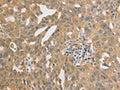 The image on the left is immunohistochemistry of paraffin-embedded Human ovarian cancer tissue using CSB-PA780249(PRDX1 Antibody) at dilution 1/20, on the right is treated with synthetic peptide. (Original magnification: ×200)