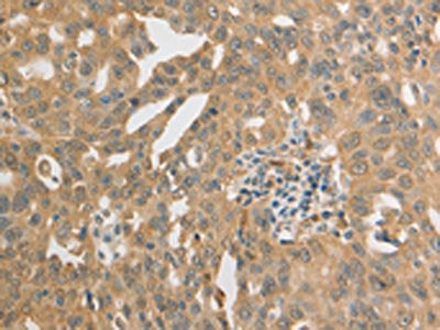 The image on the left is immunohistochemistry of paraffin-embedded Human ovarian cancer tissue using CSB-PA780249(PRDX1 Antibody) at dilution 1/20, on the right is treated with synthetic peptide. (Original magnification: ×200)