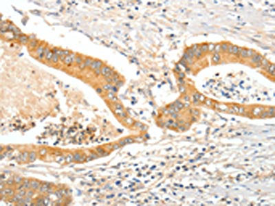 The image on the left is immunohistochemistry of paraffin-embedded Human colon cancer tissue using CSB-PA780260(APOB Antibody) at dilution 1/15, on the right is treated with synthetic peptide. (Original magnification: ×200)