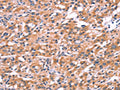 The image on the left is immunohistochemistry of paraffin-embedded Human thyroid cancer tissue using CSB-PA780526(ENDOG Antibody) at dilution 1/15, on the right is treated with synthetic peptide. (Original magnification: ×200)