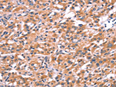The image on the left is immunohistochemistry of paraffin-embedded Human thyroid cancer tissue using CSB-PA780526(ENDOG Antibody) at dilution 1/15, on the right is treated with synthetic peptide. (Original magnification: ×200)
