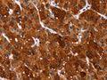 The image on the left is immunohistochemistry of paraffin-embedded Human liver cancer tissue using CSB-PA780646(HSPB6 Antibody) at dilution 1/40, on the right is treated with synthetic peptide. (Original magnification: ×200)