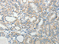 The image on the left is immunohistochemistry of paraffin-embedded Human thyroid cancer tissue using CSB-PA780863(AGAP1 Antibody) at dilution 1/25, on the right is treated with synthetic peptide. (Original magnification: ×200)