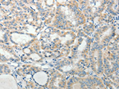 The image on the left is immunohistochemistry of paraffin-embedded Human thyroid cancer tissue using CSB-PA780863(AGAP1 Antibody) at dilution 1/25, on the right is treated with synthetic peptide. (Original magnification: ×200)
