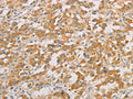 The image on the left is immunohistochemistry of paraffin-embedded Human thyroid cancer tissue using CSB-PA781119(ZWINT Antibody) at dilution 1/50, on the right is treated with fusion protein. (Original magnification: ×200)