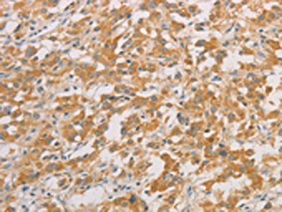 The image on the left is immunohistochemistry of paraffin-embedded Human thyroid cancer tissue using CSB-PA781119(ZWINT Antibody) at dilution 1/50, on the right is treated with fusion protein. (Original magnification: ×200)
