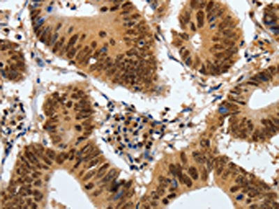 The image on the left is immunohistochemistry of paraffin-embedded Human colon cancer tissue using CSB-PA781273(COPS5 Antibody) at dilution 1/120, on the right is treated with fusion protein. (Original magnification: ×200)