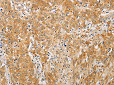 The image on the left is immunohistochemistry of paraffin-embedded Human gastic cancer tissue using CSB-PA781587(PDE4D Antibody) at dilution 1/20, on the right is treated with fusion protein. (Original magnification: ×200)
