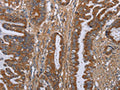 The image on the left is immunohistochemistry of paraffin-embedded Human esophagus cancer tissue using CSB-PA781691(LUM Antibody) at dilution 1/40, on the right is treated with fusion protein. (Original magnification: ×200)